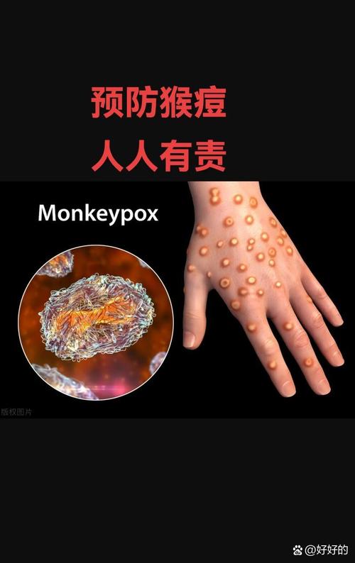 泰国确诊第12例猴痘病例 患者行程及疫情总体情况公布