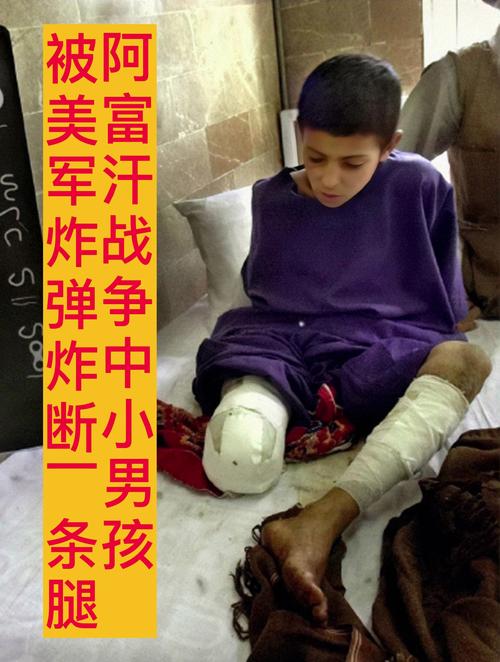 丹麦士兵马克·彼得斯阿富汗战场踩雷重伤,双腿尽毁